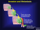 Invasion & metastasis.